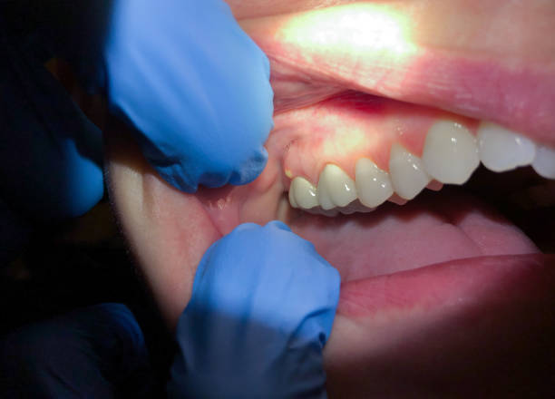Best Knocked-Out Tooth (Avulsed Tooth) Treatment in Warsaw, VA